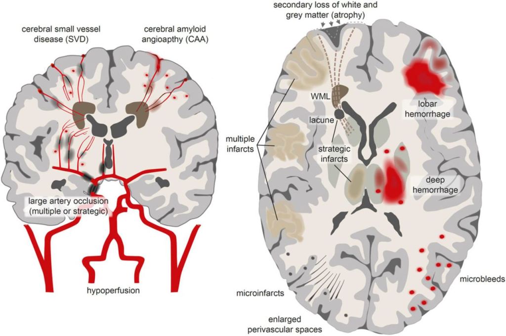 Brain + Blood: Redefining Cognitive Impairment with the VasCog-2-WSO&nbsp;Criteria
